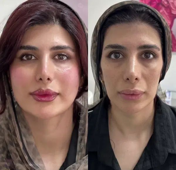 تزریق تخصصی ژل وبوتاکس،هایفو،پاک کردن تتوتوسط پزشک|خدمات آرایشگری و زیبایی|کرمانشاه, |دیوار
