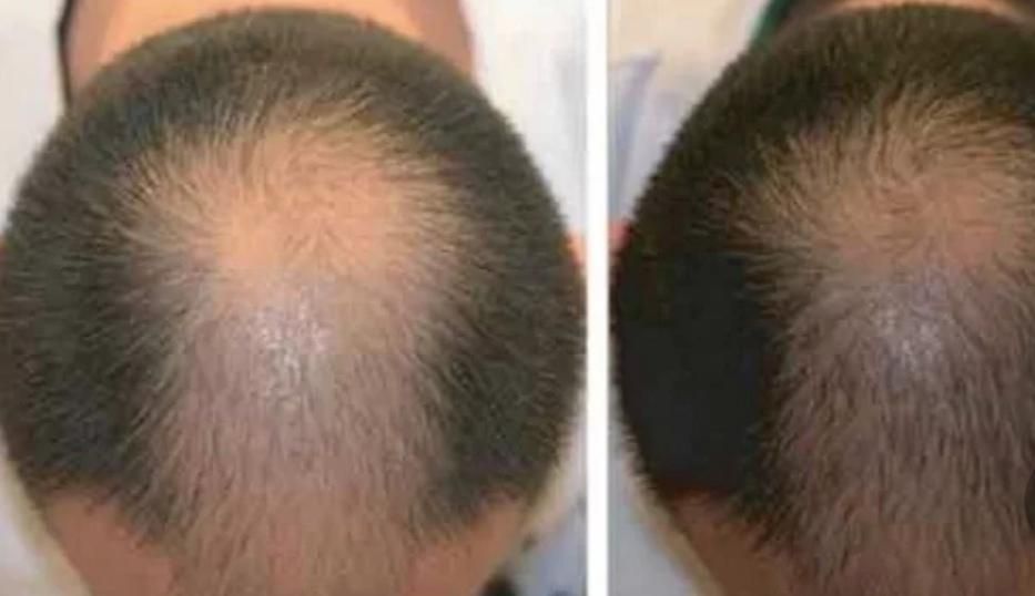 رفع جای جوش ،ریزش مو ،خال برداری برای آقایان|خدمات آرایشگری و زیبایی|خرمشهر, |دیوار