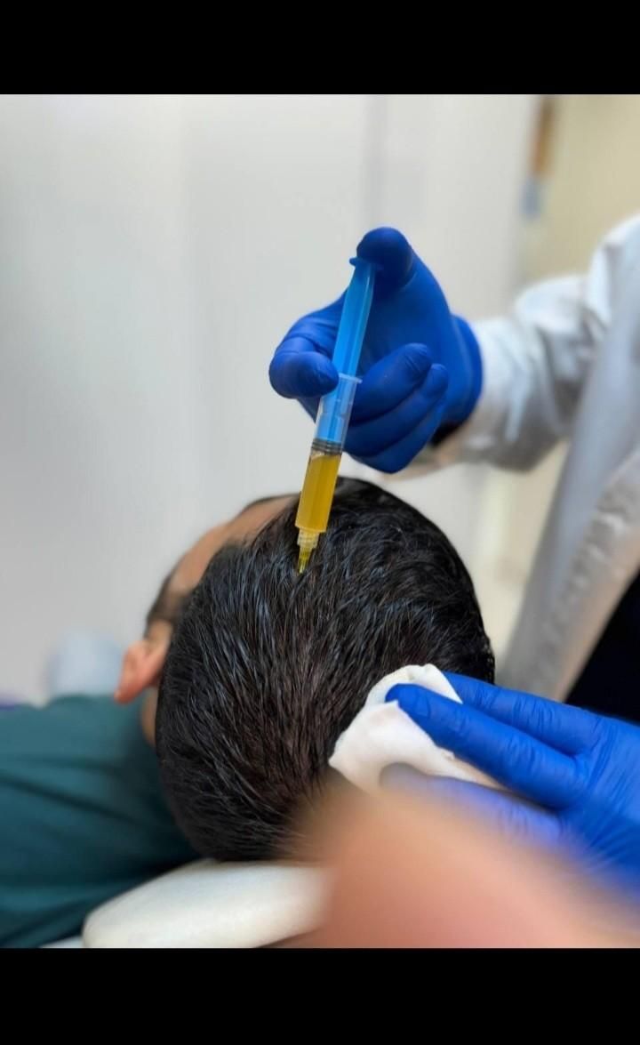 پی ارپی،مزو تراپی مو و صورت|خدمات آرایشگری و زیبایی|خرمآباد, |دیوار