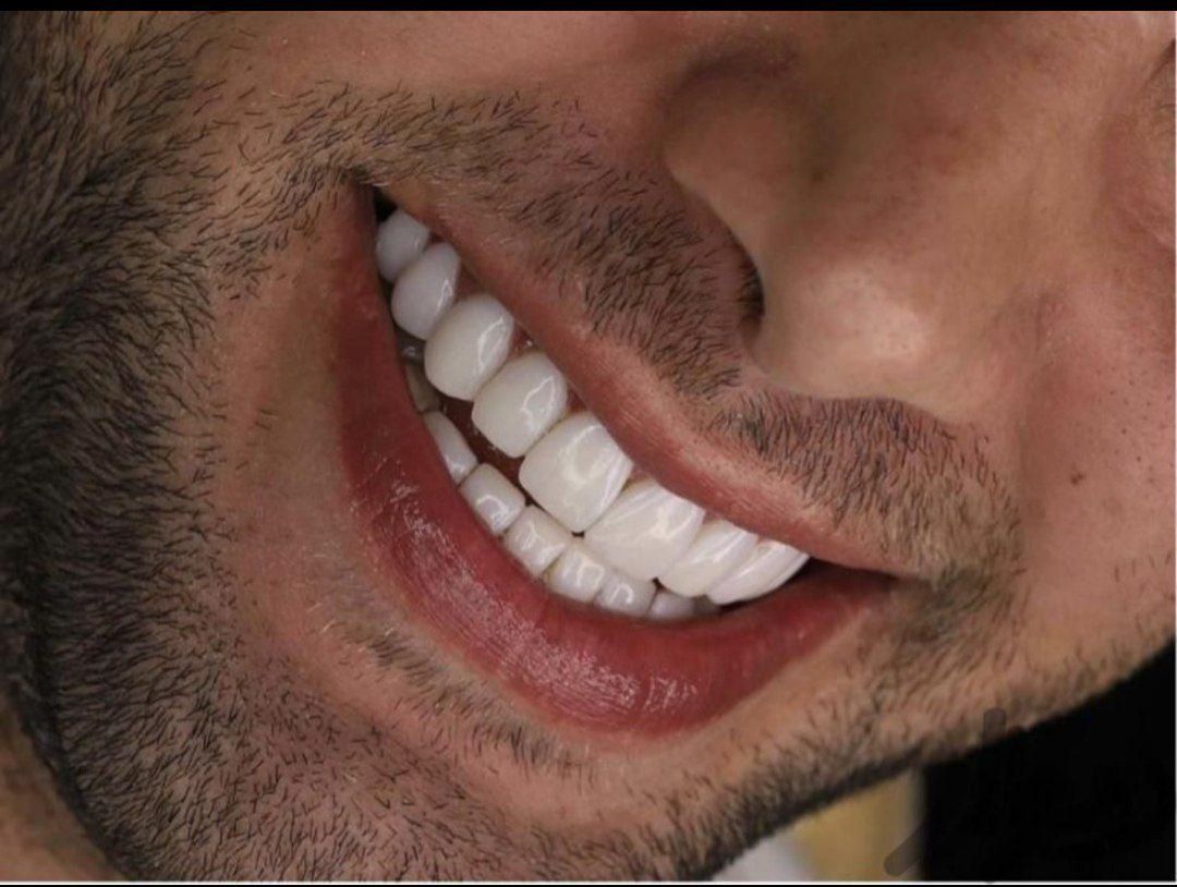 دندانسازی خیریه طرح لمینت|خدمات آرایشگری و زیبایی|مشهد, عامل|دیوار