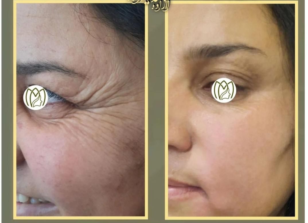 ژل بوتاکس،لابیاپلاستی،حذف لک،ریموو تتو،لاغری|خدمات آرایشگری و زیبایی|ارومیه, |دیوار