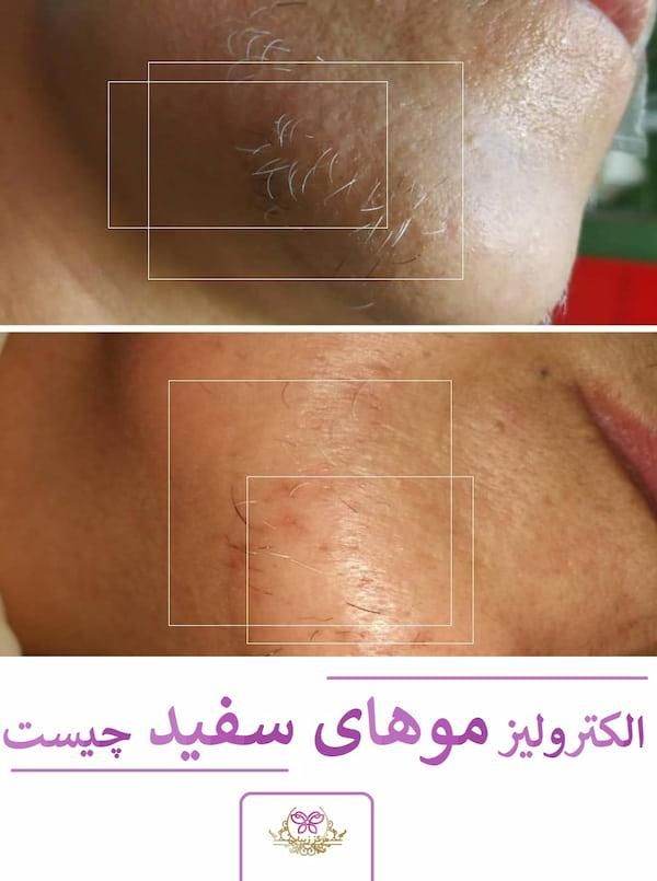 آموزش الکترولیز|خدمات آموزشی|قشم, |دیوار