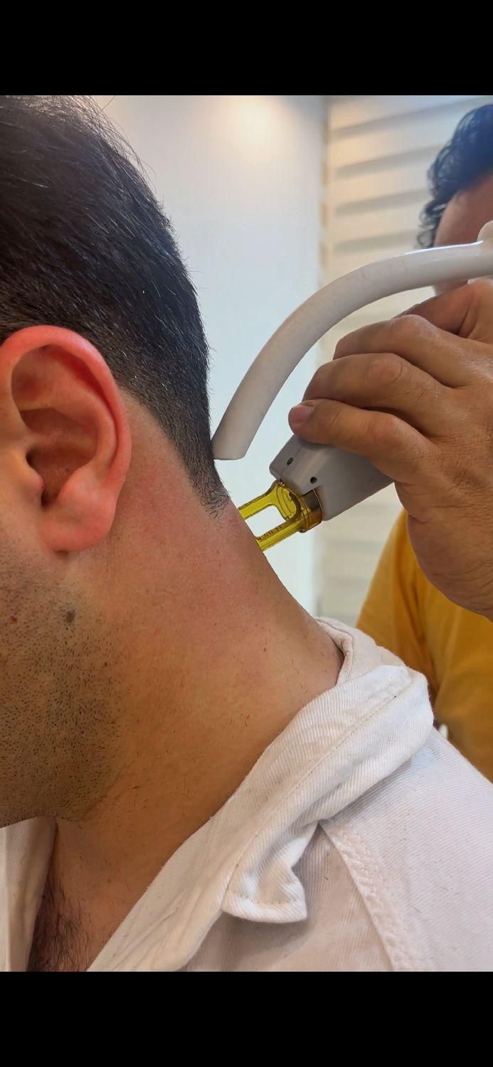 لیزرموهای زائدبادستگاه کندلاآمریکایی کلینیک راویس|خدمات آرایشگری و زیبایی|کاشان, رجایی|دیوار