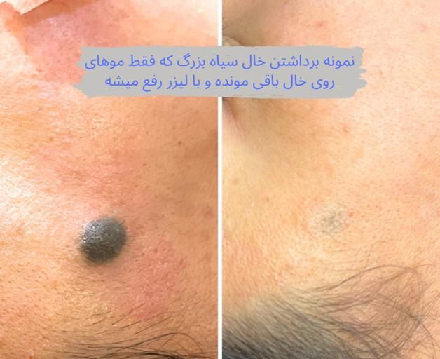 برداشتن خال/زگیل/منگوله های پوستی**|خدمات آرایشگری و زیبایی|اصفهان, مرداویج|دیوار
