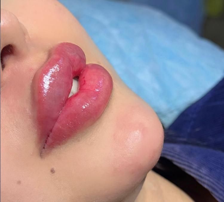 ژل بوتاکس چربی نخ|خدمات آرایشگری و زیبایی|ارومیه, |دیوار