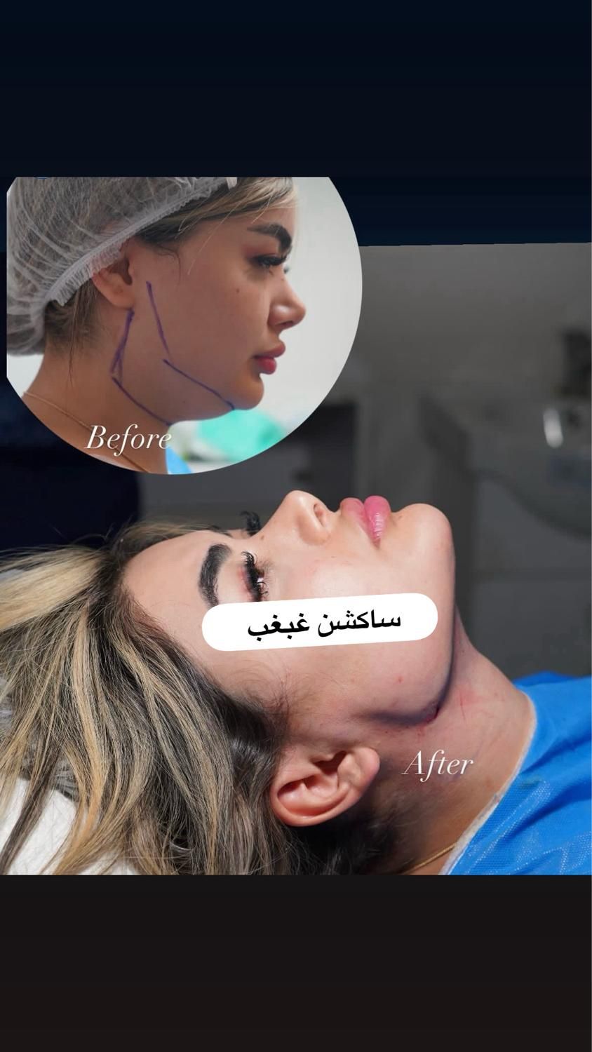 ساکشن غبغب بلفارو کاشت ابرو بوکال فت|خدمات آرایشگری و زیبایی|تهران, میرداماد|دیوار