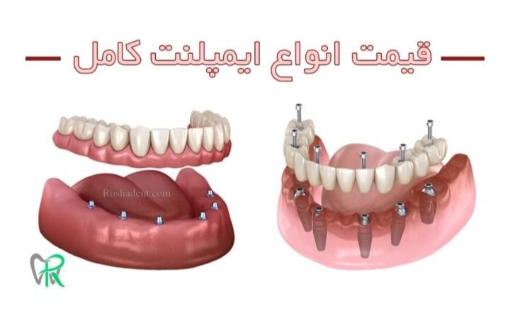 مرکز ایمپلنت با متخصصان با تجربه|خدمات آرایشگری و زیبایی|اصفهان, باغ فدک|دیوار
