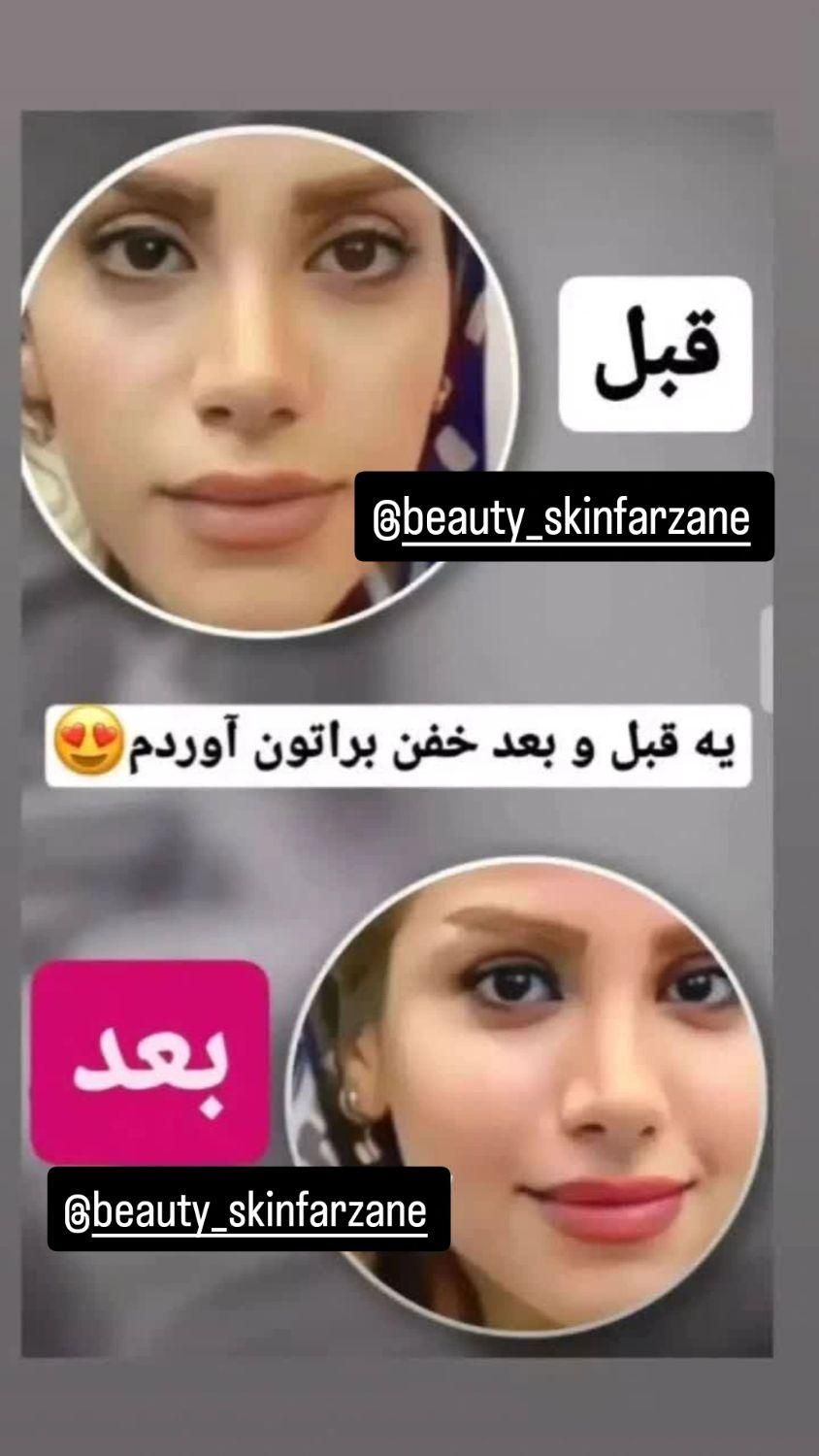 تپلی صورت|آرایشی، بهداشتی، درمانی|رشت, بلوار گیلان|دیوار