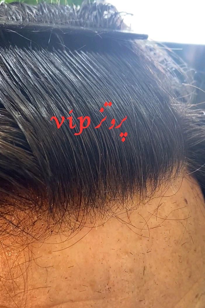پروتزمو هشت تیکه وارداتی قیمت همراه نصب|آرایشی، بهداشتی، درمانی|تهران, مسعودیه|دیوار