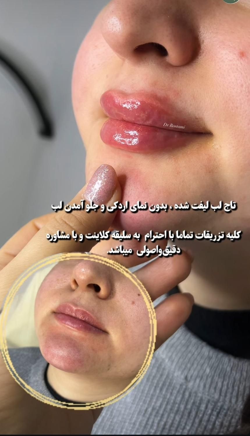 لیزر موهای زاید تزریق بوتاکس وژل  توسط پزشک|خدمات آرایشگری و زیبایی|تالش, هشتپر|دیوار