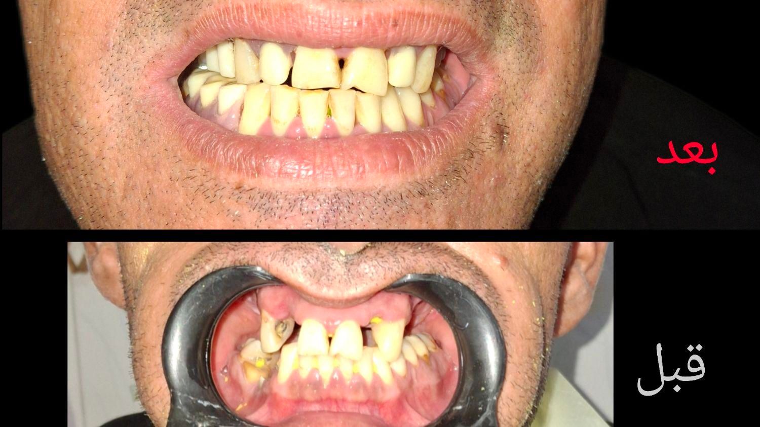 ساخت دندان مصنوعی اقتصادی وبا کیفیت|خدمات آرایشگری و زیبایی|ری, دیلمان|دیوار