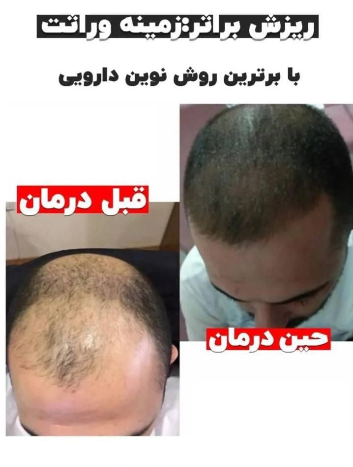 مشاوره ریزش مو و رویش مجدد|خدمات آرایشگری و زیبایی|مشهد, کلاهدوز|دیوار