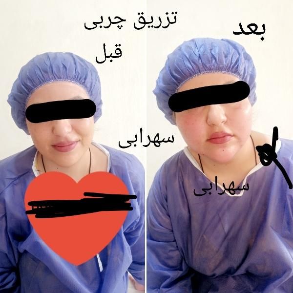 تزریق چربی صورت|خدمات آرایشگری و زیبایی|یاسوج, |دیوار