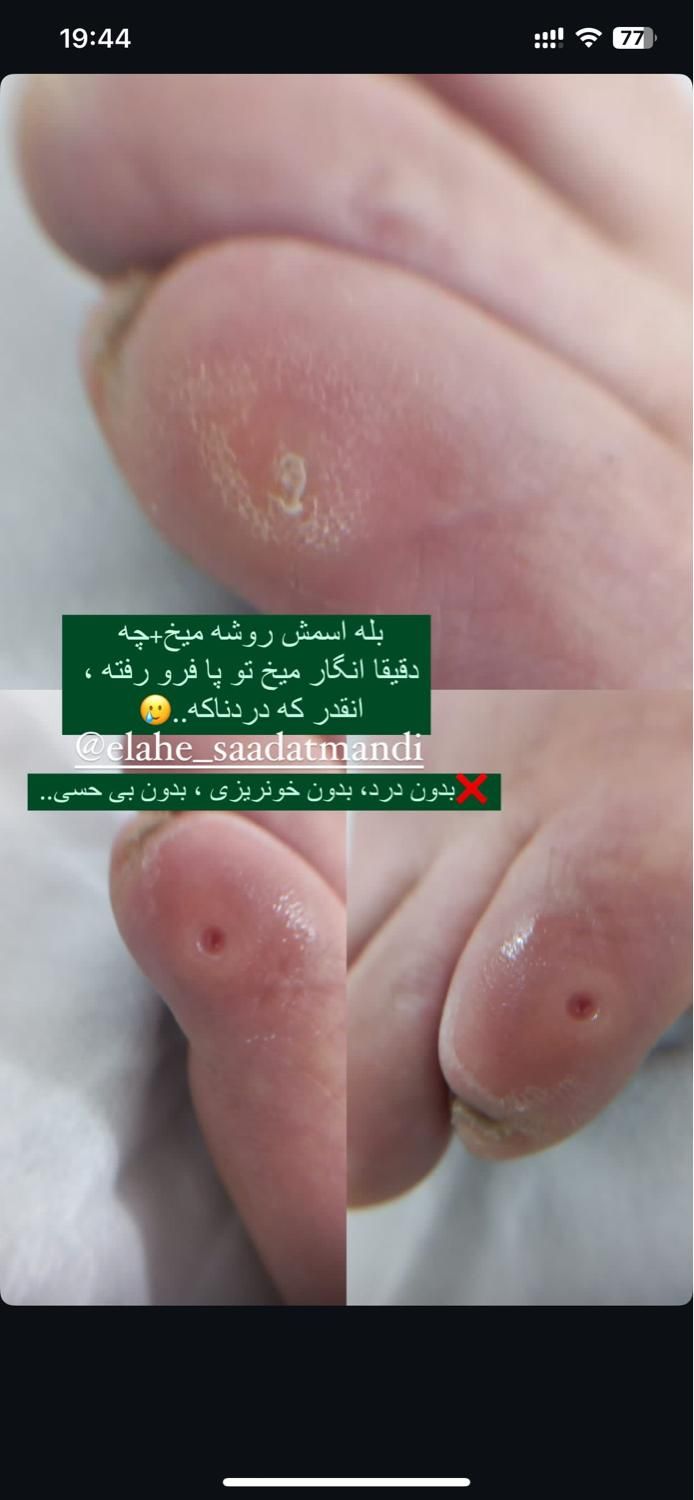 خدمات پودولوژی و پدیکور درمانی ، تخلیه میخچه و ..|خدمات آرایشگری و زیبایی|تهران, فردوس|دیوار