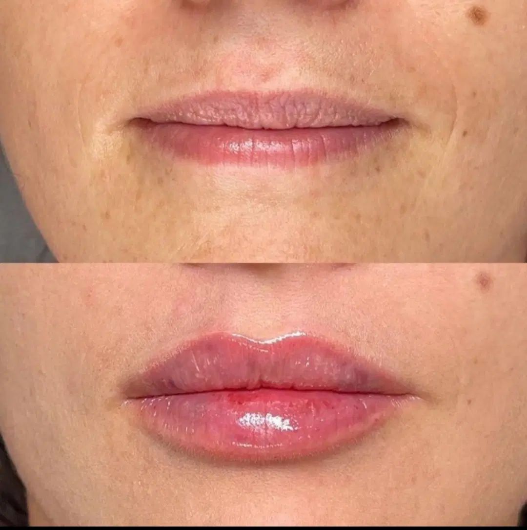 تزریق ژل .بوتاکس .انزیم بینی .مزوژل جوانساز|خدمات آرایشگری و زیبایی|جهرم, |دیوار