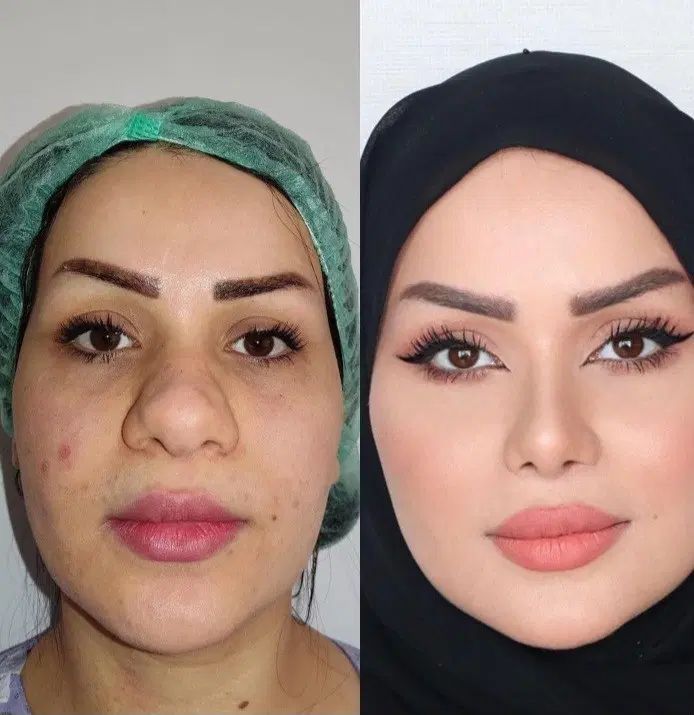 عمل جراحی بینی وترمیم باپیزو/لیفت صورت وپلک|خدمات آرایشگری و زیبایی|کرج, چهارصد دستگاه|دیوار