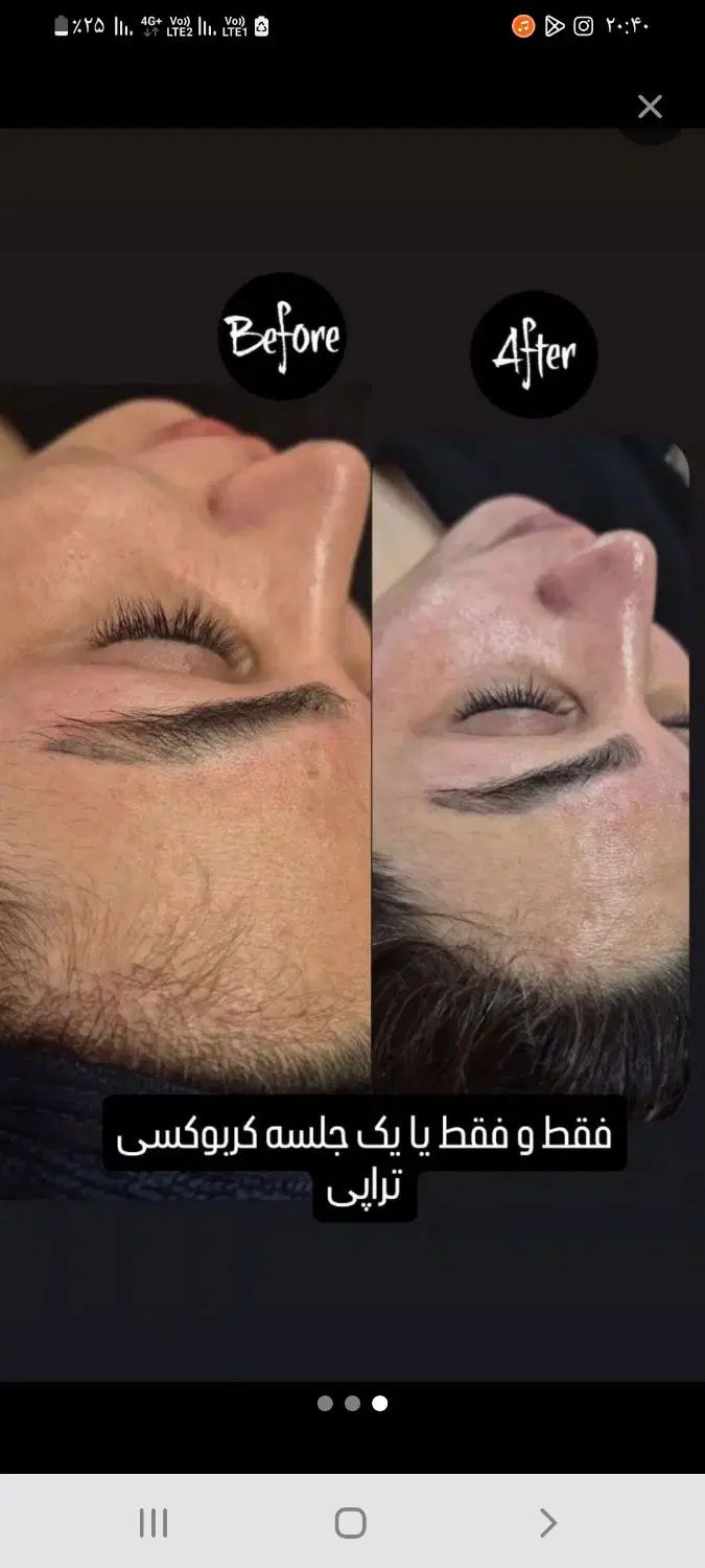 خدمات و آموزش فیشیال مزوتراپی میکروندلینگ|خدمات آرایشگری و زیبایی|اهواز, حصیرآباد|دیوار