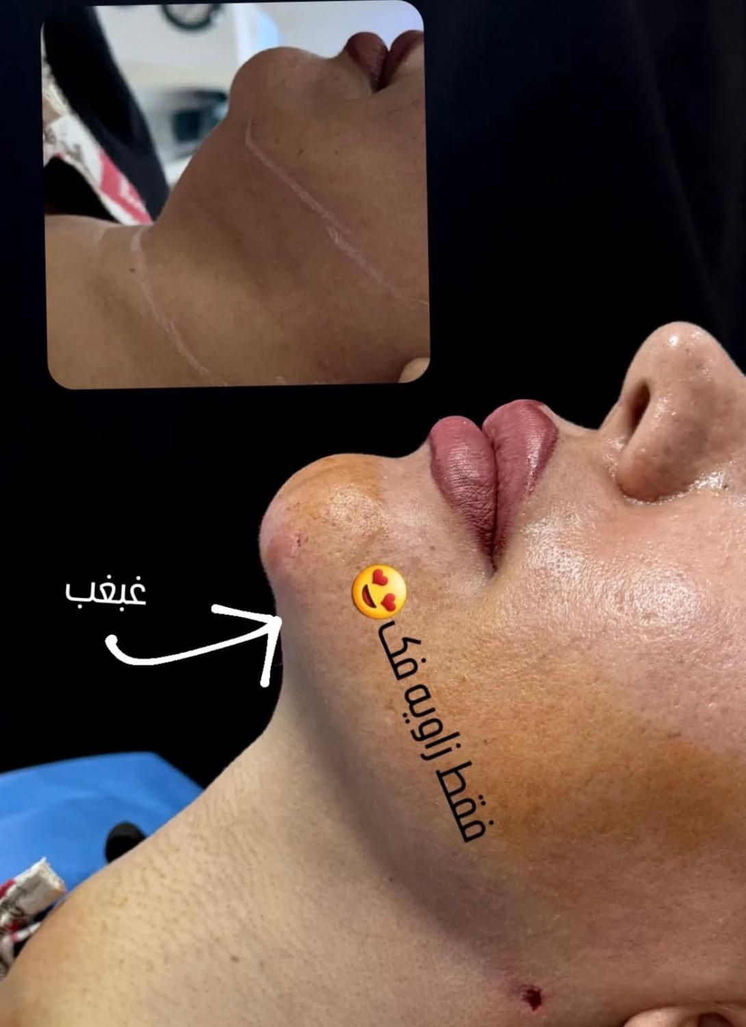 لیپوساکشن شکم و پهلو،ترنسفر به باسن،هایفودابلوگولد|خدمات آرایشگری و زیبایی|اصفهان, دشتستان|دیوار