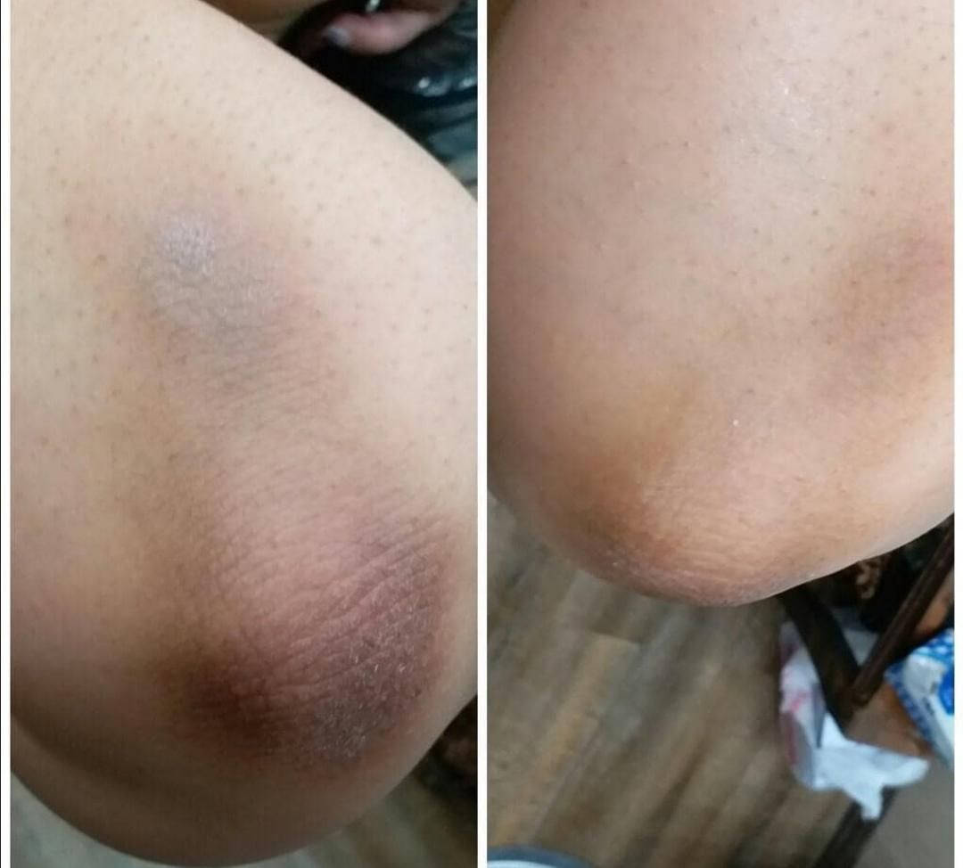 ازبین بردن تیرگی ،ازبین بردن ترک عمیق پا|خدمات آرایشگری و زیبایی|بوشهر, |دیوار