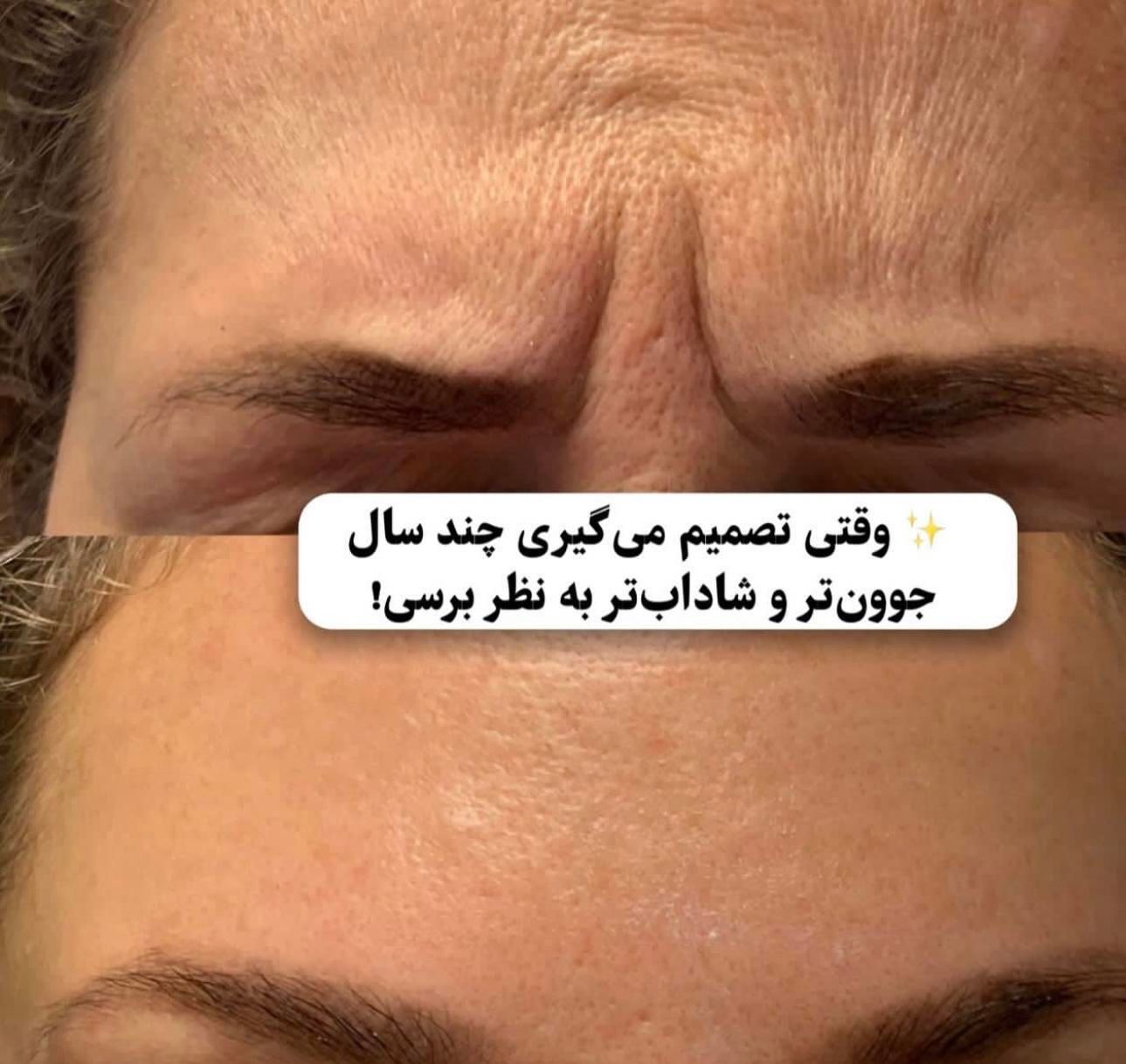 تزریق بوتاکس با بهترین متد|خدمات آرایشگری و زیبایی|مشهد, مصلی (کارمندان اول)|دیوار