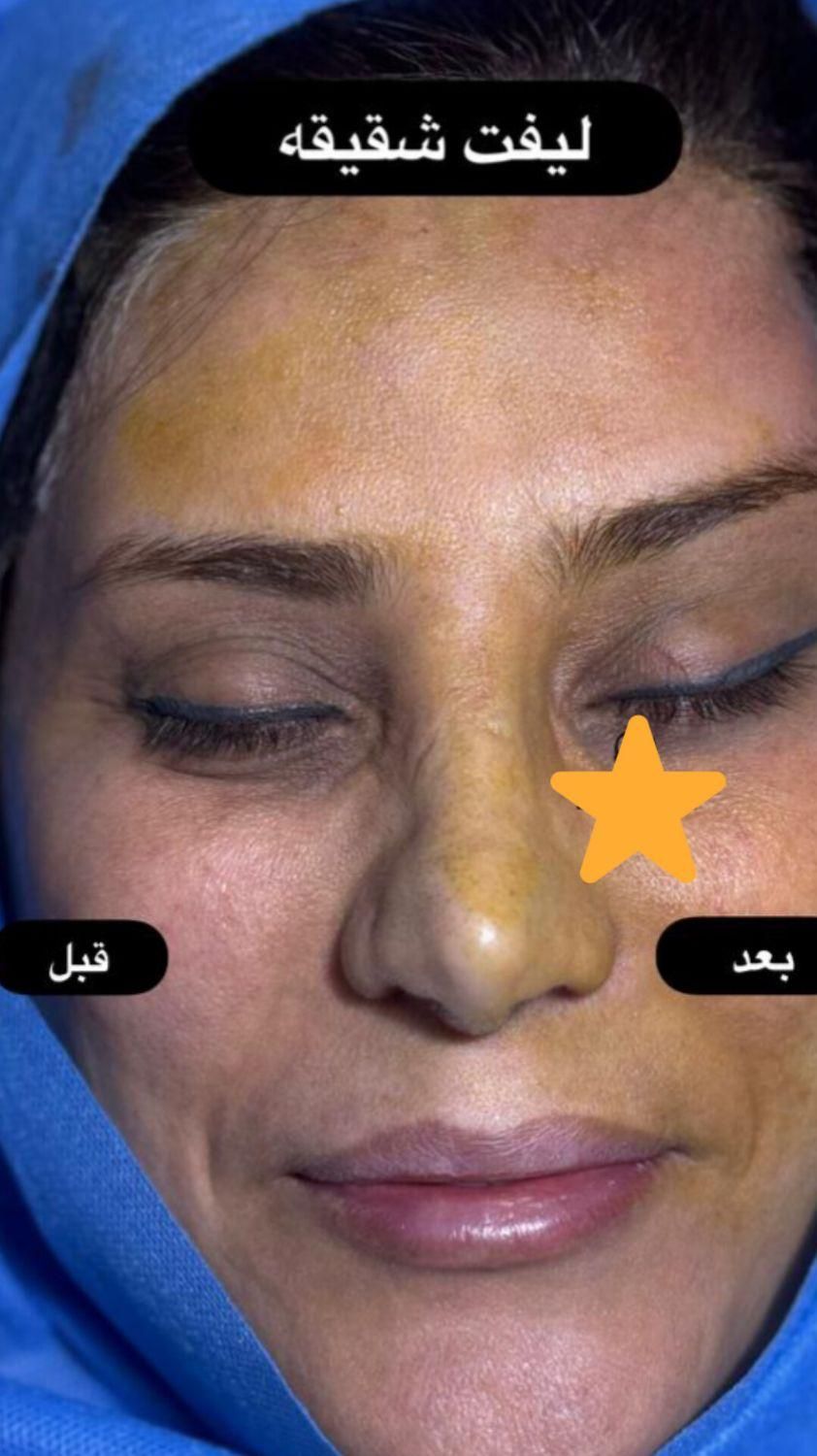 لیفت شقیقه بلفاروپلاستی|خدمات آرایشگری و زیبایی|تهران, میرداماد|دیوار