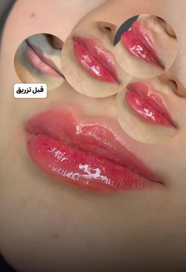 جشنواره تخفیف پی آر پی و ژل و بوتاکس|خدمات آرایشگری و زیبایی|شیراز, زرگری|دیوار