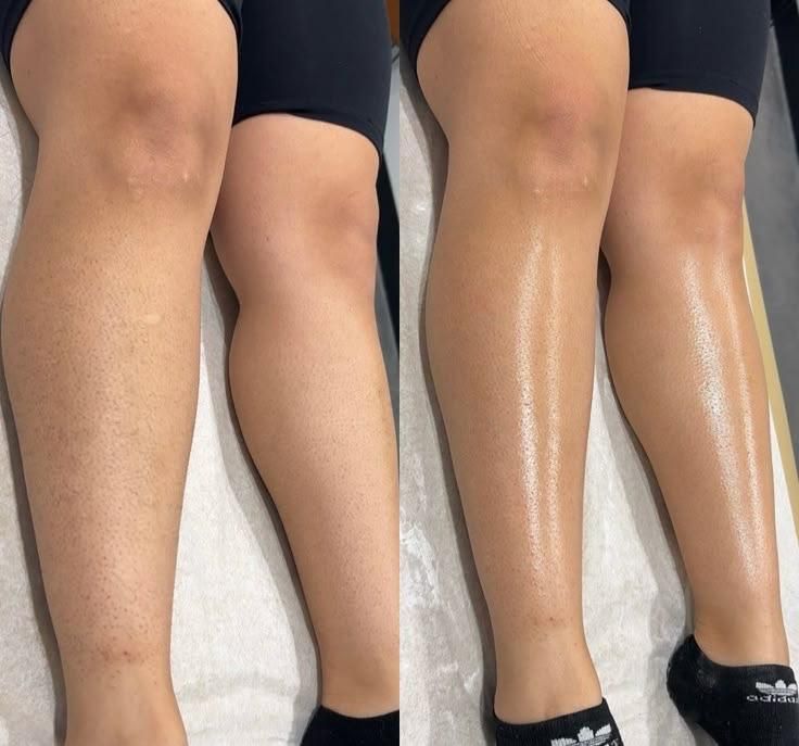 لیزر مو های زایددستگاه کندلا (شاتی ) بهترین۲۰۲۵|خدمات آرایشگری و زیبایی|کرج, احدآباد|دیوار