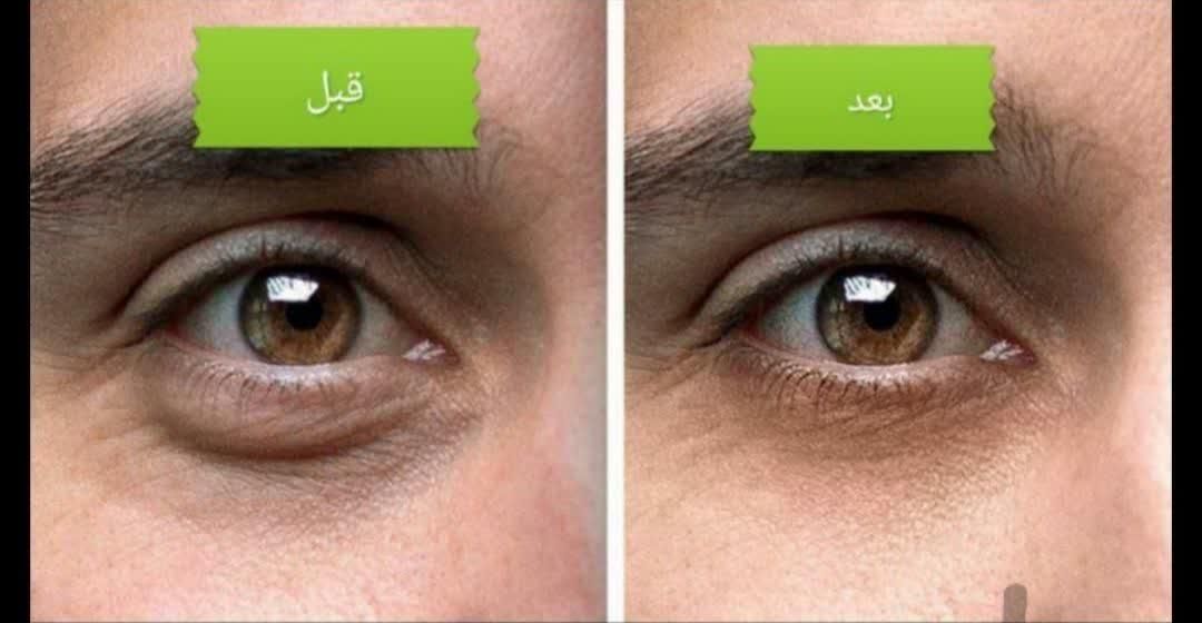 عمل رفع افتادگی پلک / رفع پف زیر چشم|خدمات آرایشگری و زیبایی|خمینی‌شهر, |دیوار