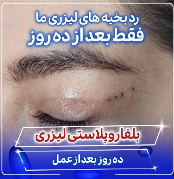 بلفاروپلاستی(جراحی پلک بالا و پایین)توسط چشم پزشک|خدمات آرایشگری و زیبایی|یاسوج, |دیوار