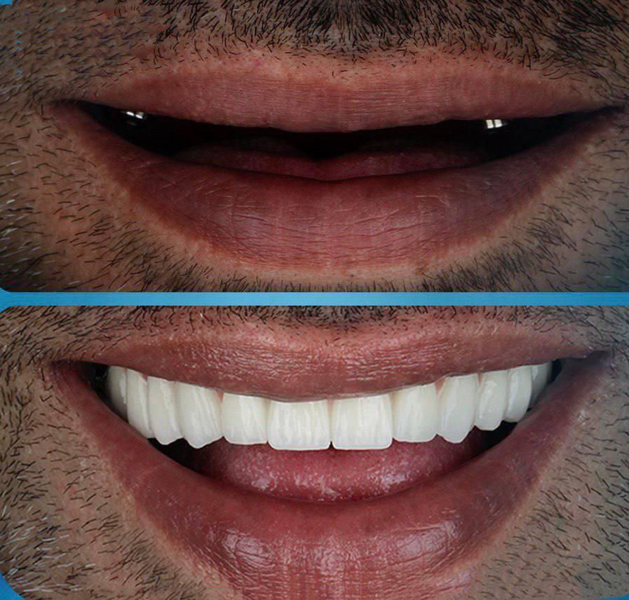 کامپوزیت ایمپلنت ارتودنسی بندرعباس|خدمات آرایشگری و زیبایی|بندرعباس, |دیوار