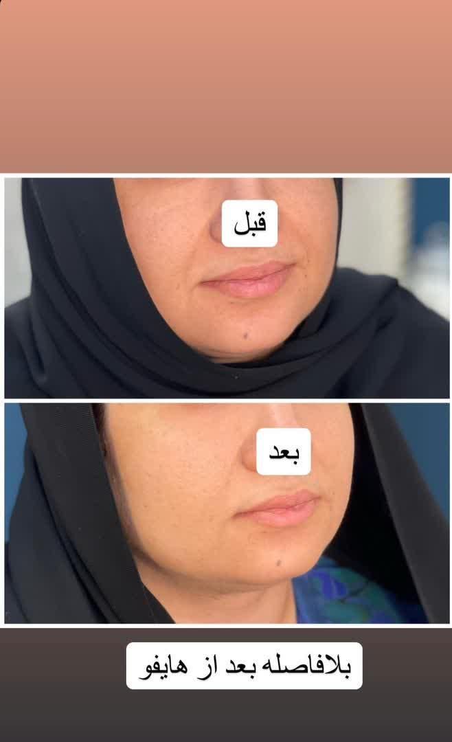 هایفوتراپی14بعدی برای نخستین بار در غرب کشور|خدمات آرایشگری و زیبایی|خرم‌آباد, |دیوار