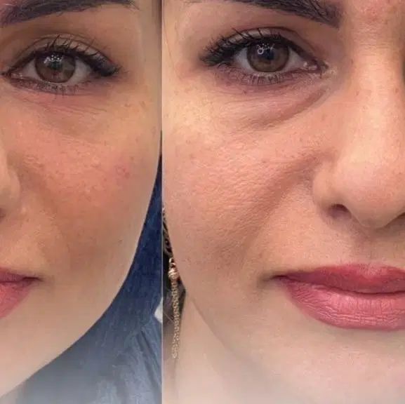 جشنوارتخفیفات ژل و بوتاکس توسط شخص پزشک|خدمات آرایشگری و زیبایی|قم, زنبیل آباد|دیوار