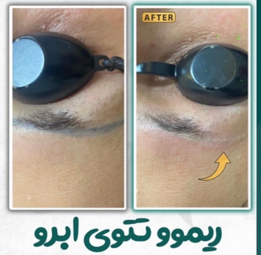 پاک کردن تتو ابرو و ریموو خالکوبی بدن توسط پزشک|خدمات آرایشگری و زیبایی|رشت, گلسار|دیوار
