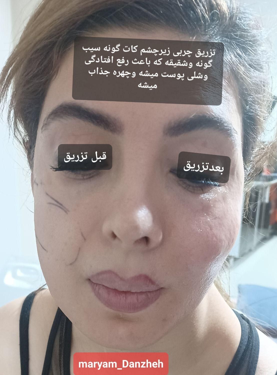 ساکشن وتزریق چربی فیلروبوتاکس وپی ارپی سروصورت ونخ|خدمات آرایشگری و زیبایی|اندیشه, |دیوار