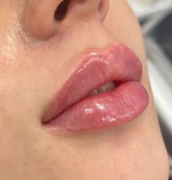 تزریق ژل بوتاکس لیزر هایفو مزو پی ار پی نخ فیشیال|خدمات آرایشگری و زیبایی|شهریار, |دیوار