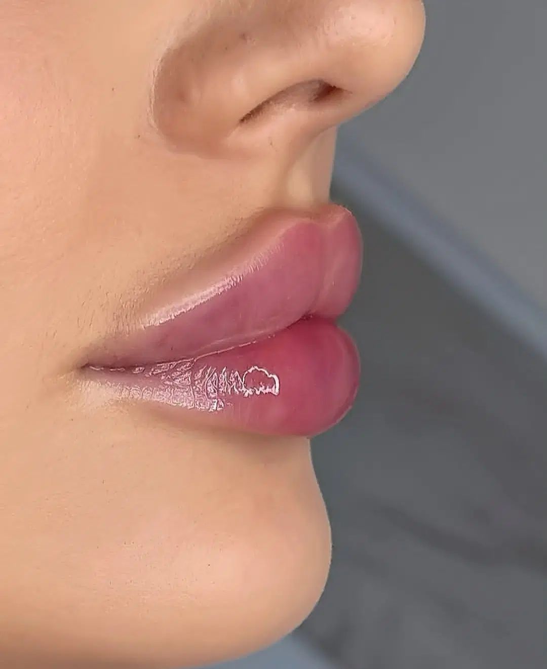 ژل بوتاکس فیلر زاویه سازی خط لبخند لیزر مطب پزشک|خدمات آرایشگری و زیبایی|قم, ارم|دیوار