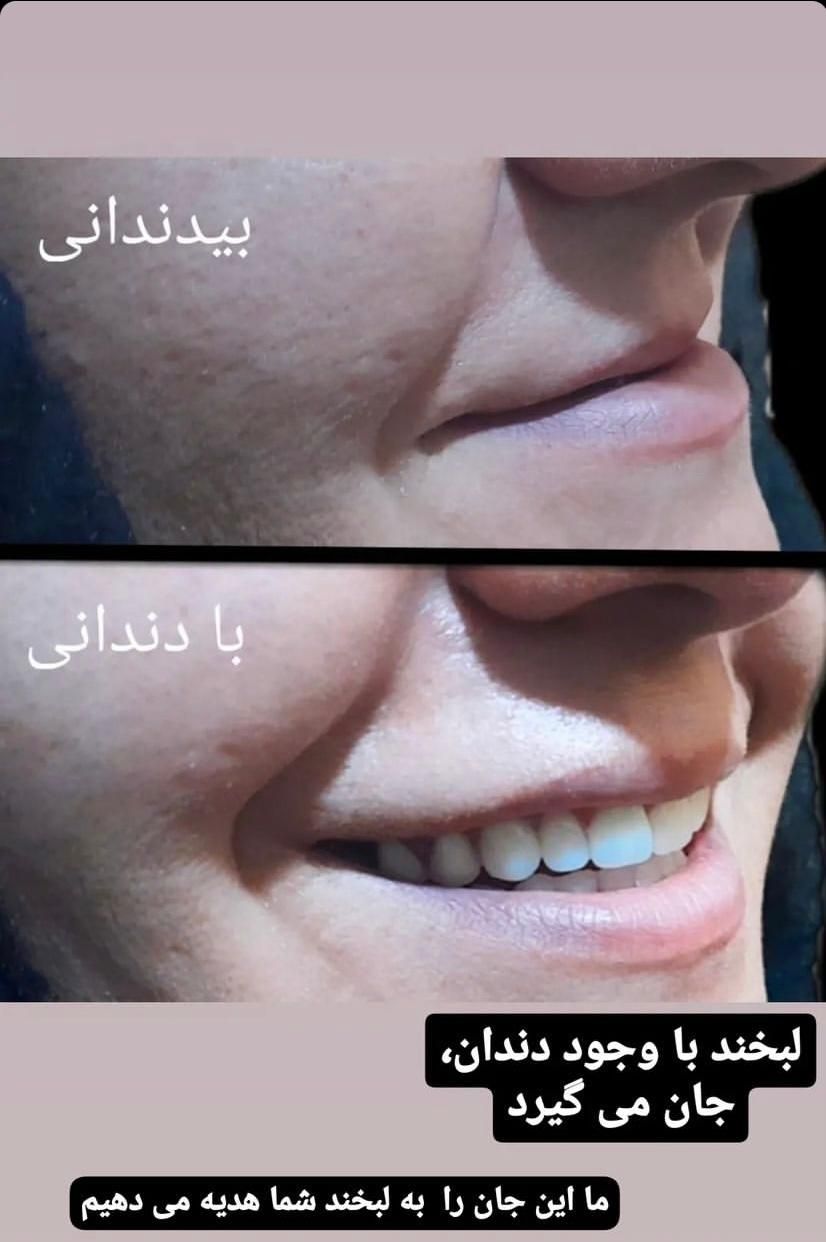 دندانسازی دندان سازی دندان مصنوعی پروتز|خدمات آرایشگری و زیبایی|مشهد, ولیعصر (امامیه)|دیوار