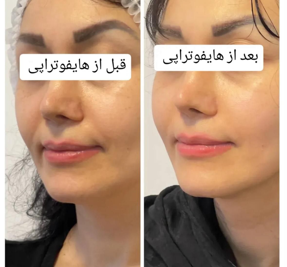 جوانسازی و لیفت صورت و بدن بدون جراحی و درد(هایفو)|خدمات آرایشگری و زیبایی|مشهد, کوثر|دیوار