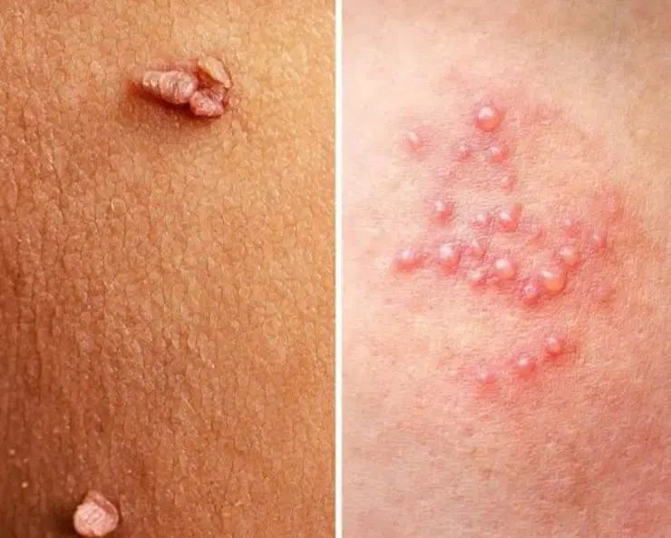 بهبود زگیل و تبخال|خدمات آرایشگری و زیبایی|رشت, گلسار|دیوار