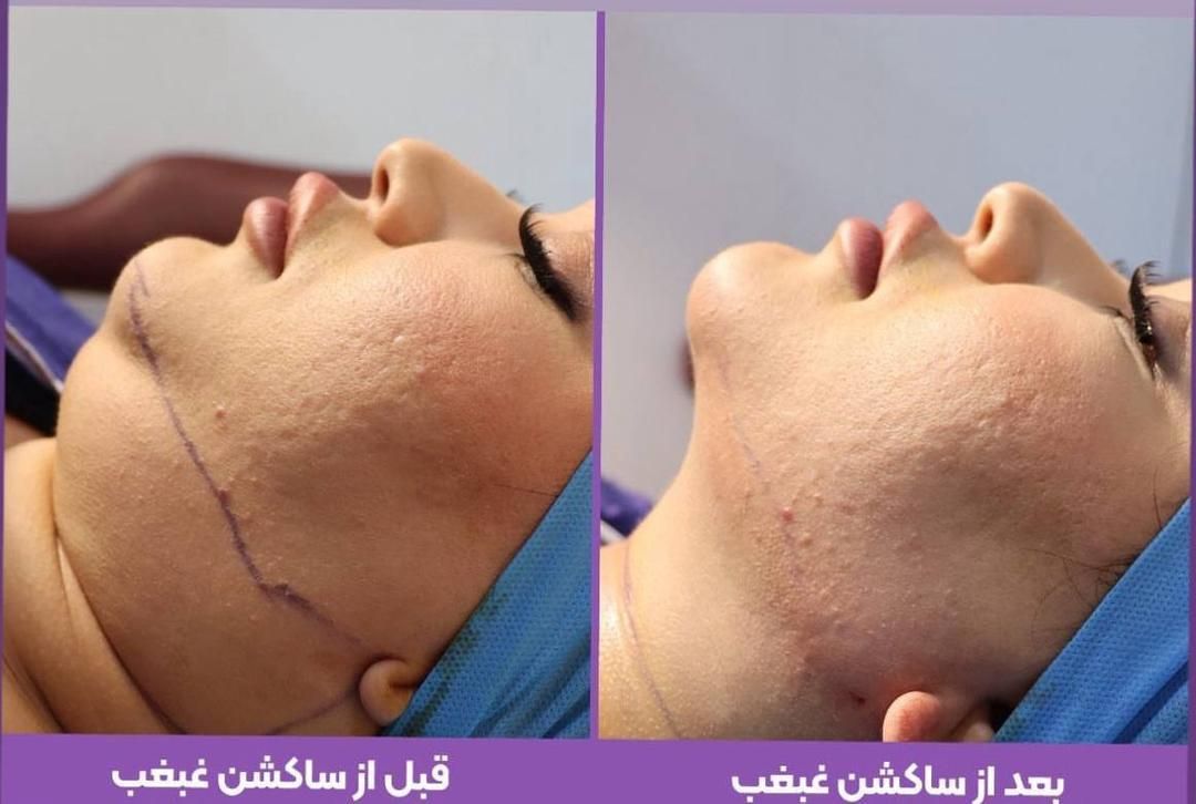 جشنواره ی تخفیف بلفاروپلاستی پلک و ساکشن غبغب|خدمات آرایشگری و زیبایی|تهران, سعادت‌آباد|دیوار