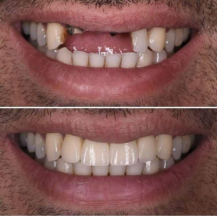 ایمپلنت اقساطی|خدمات آرایشگری و زیبایی|قم, زنبیل آباد|دیوار