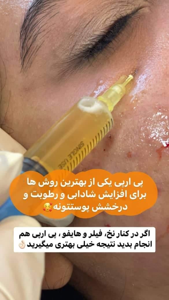 کاشت مــو/لیزر مو زائد/لاغری/فیلر بادی/ نخ بوتاکس|خدمات آرایشگری و زیبایی|شیراز, کیان شهر|دیوار