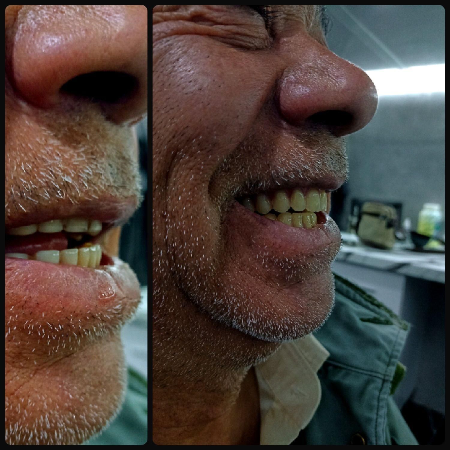 دندان مصنوعی(بدون واسطه خرید کن)|خدمات آرایشگری و زیبایی|قرچک, باقرآباد|دیوار