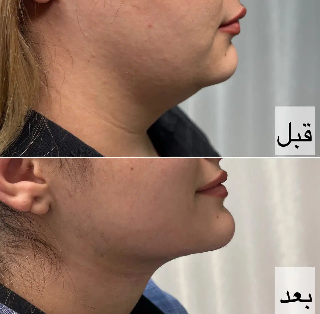ساکشن غبغب ۳/۵۰۰تومن|خدمات آرایشگری و زیبایی|مشهد, فرهنگ|دیوار