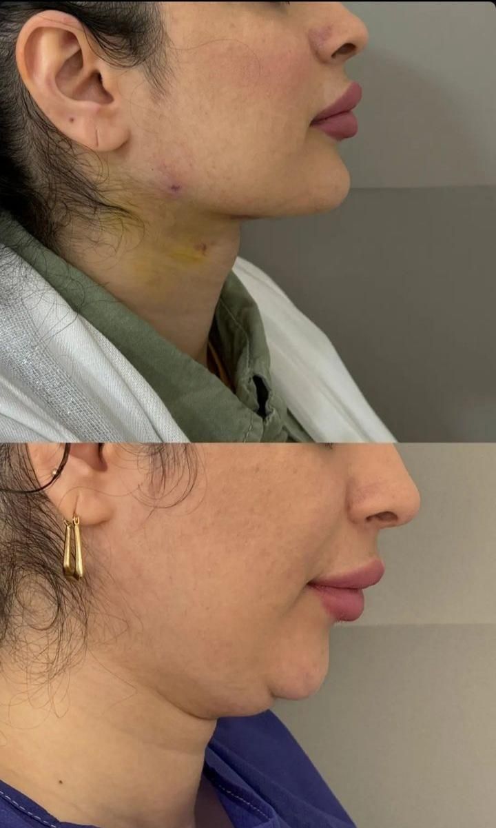 ساکشن شکم پهلو غبغب تزریق چربی ژل بوتاکس|خدمات آرایشگری و زیبایی|کرمانشاه, |دیوار