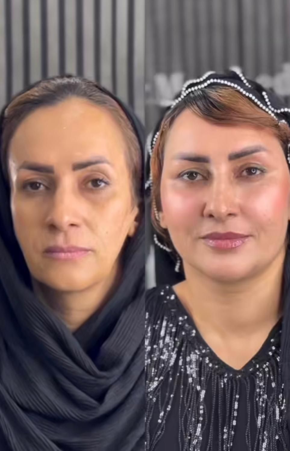 لیفت و جوانسازی صورت با ارزان ترین قیمت توسط پزشک|خدمات آرایشگری و زیبایی|مشهد, هنرستان|دیوار