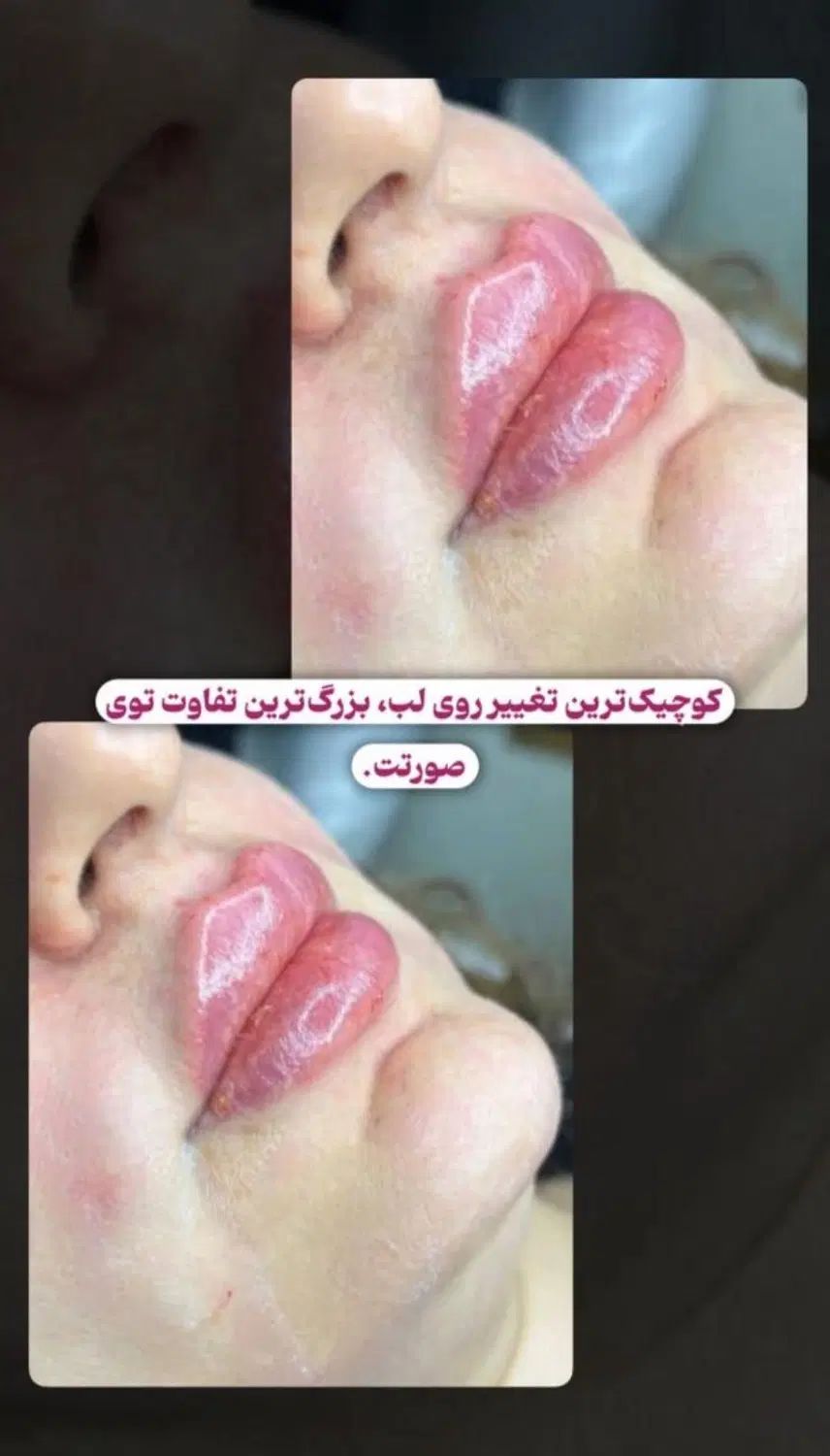 خدمات تزریقات فیلر(ژل)وبوتاکس باپترووآزاد|خدمات آرایشگری و زیبایی|بندر ماهشهر, |دیوار