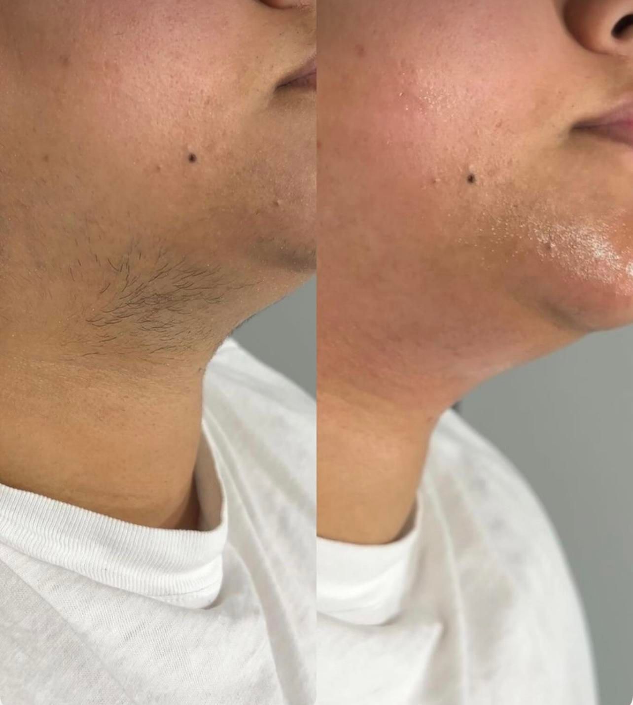 کلینیک لیزر موهای زائد|خدمات آرایشگری و زیبایی|خمینیشهر, |دیوار