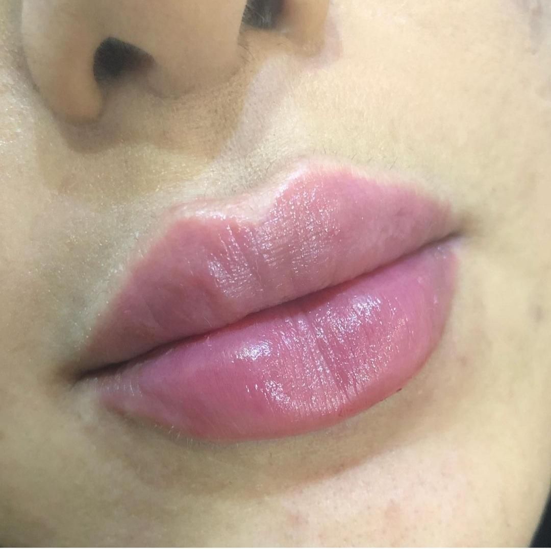 بوتاکس ،فیلر و ژل لب ، لیفت نخ ، انزیم ،مزوتراپی|خدمات آرایشگری و زیبایی|مشهد, جانباز|دیوار