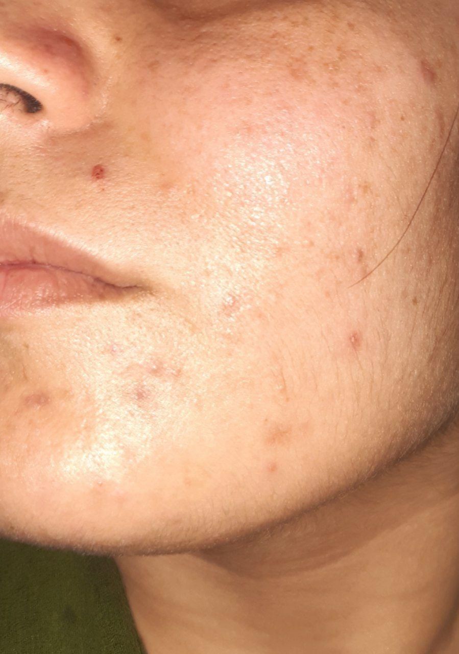 کرم ضدلک قوی سفیدکننده|آرایشی، بهداشتی، درمانی|جوانرود, |دیوار